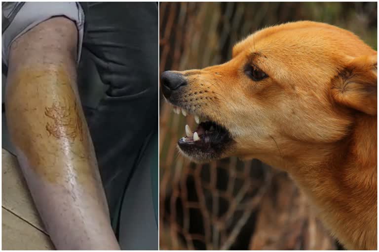 Burdwan Dog Bite problem