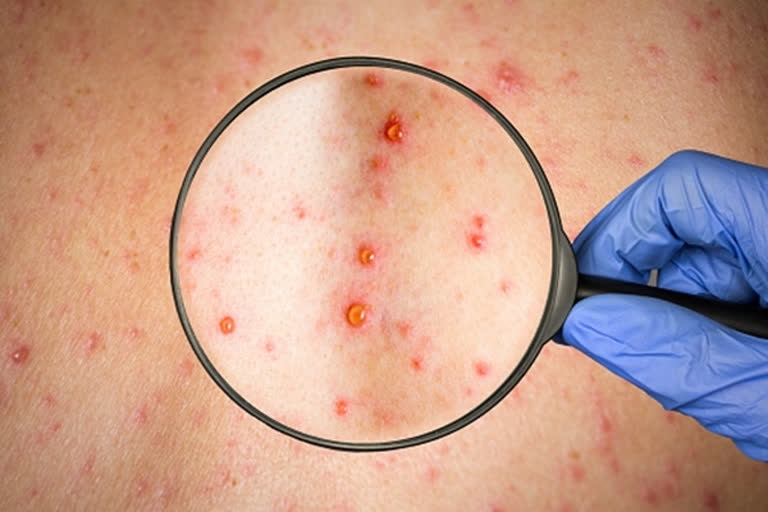 Monkeypox case in Massachusetts