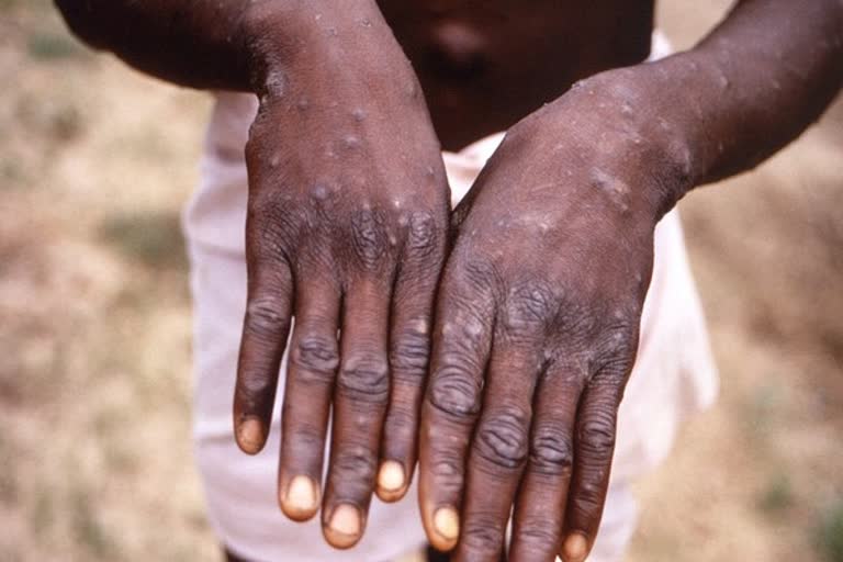 Monkeypox India alert