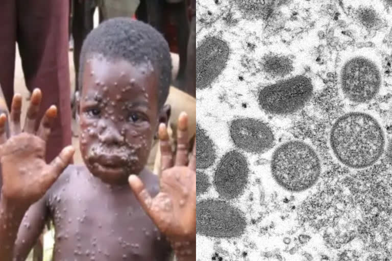 EXPLAINER: What is monkeypox and where is it spreading?  monkey pox in detail  what is monkey pox  what are the symptoms of monkey pox  how the monkey pox spread  എന്താണ് മങ്കി പോക്‌സ്  മങ്കി പോക്‌സിന്‍റെ രോഗ ലക്ഷണങ്ങള്‍ എന്തെല്ലാം  മങ്കി പോക്‌സ് കേസുകള്‍ എത്ര  മങ്കി പോക്‌സ് പകരുന്നത് ലൈംഗീക ബന്ധത്തിലൂടെയോ