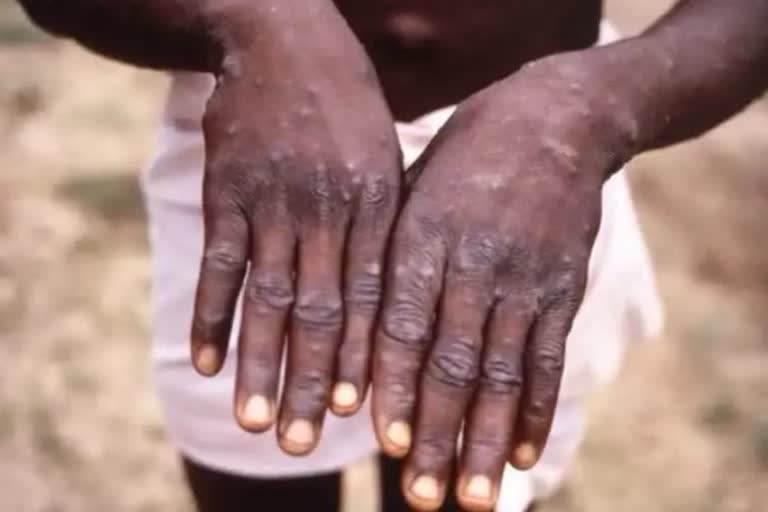 Monkeypox Cases