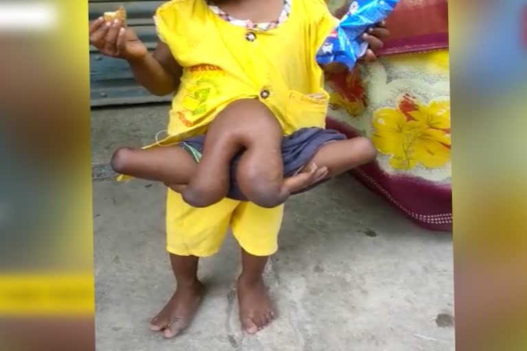 child-with-4-hand-4-leg-in-nawada