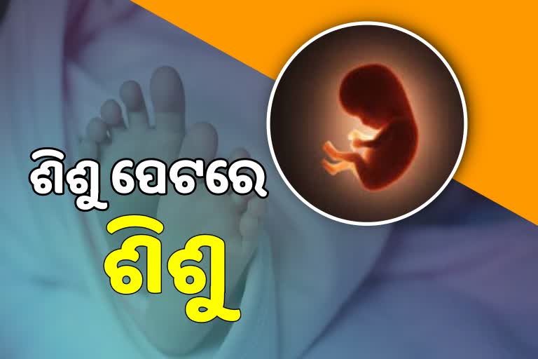 Fetus in Fetu: ପ୍ରକୃତିର ବିଚିତ୍ର ସୃଷ୍ଟି, ୪୦ ଦିନର ଶିଶୁ ପେଟର ଆଉ ଏକ ଶିଶୁ ଠାବ