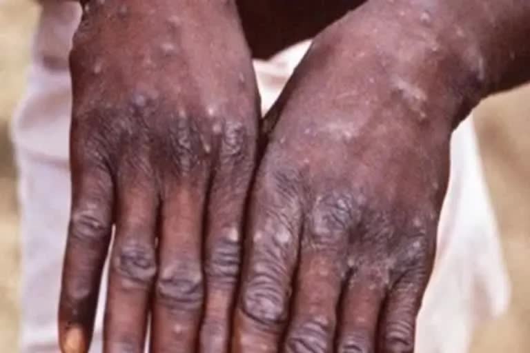 Monkeypox virus suspected case in Ghaziabad