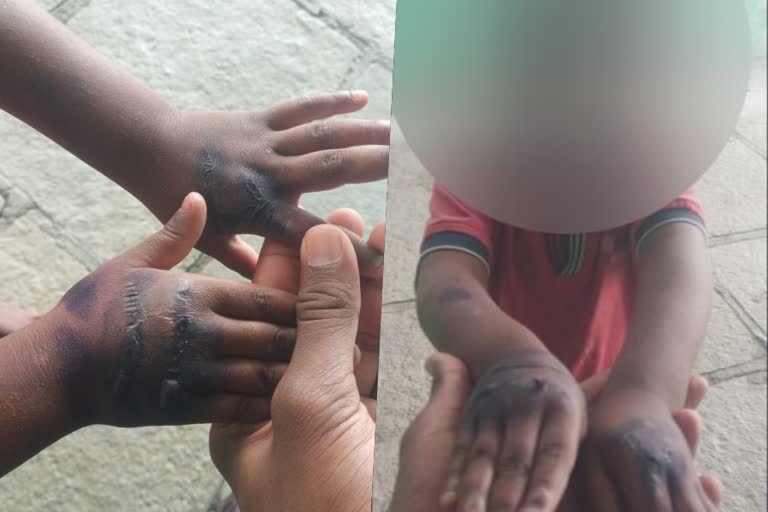 Stepmother burned child's hands for asking meal at Kalaburagi  childs hands burned by stepmother  Wadi police station  stepmother burnt her childs hands  tied the child to a cot and tortured  stepmother burnt her childs hands after the child ask for food  ഭക്ഷണം ആവശ്യപ്പെട്ടതിന് കുട്ടിയുടെ കൈ പൊള്ളിച്ച് രണ്ടാനമ്മ  നാല് വയസുകാരനെ ഉപദ്രവിച്ച് രണ്ടാനമ്മ  കുട്ടിയെ കട്ടിലിൽ കെട്ടിയിട്ട് ഉപദ്രവിച്ച്  വാഡി ടൗണിൽ രണ്ടാനമ്മയുടെ പീഡനം