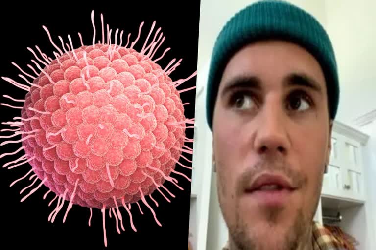 Ramsay Hunt Syndrome  Justin bibber disease  how to treat Ramsay Hunt Syndrome  symptoms of Ramsay Hunt Syndrome  റാംസെ ഹണ്ട് രോഗം എന്താണ്  റാസെ ഹണ്ടിന്‍റെ കാരണങ്ങള്‍  റാസം ഹണ്ടിന്‍റെ ലക്ഷണങ്ങള്‍  ജസ്റ്റിന്‍ ബീബറിന് വന്ന അസുഖം