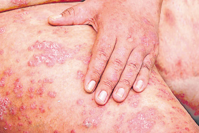 HCU on psoriasis