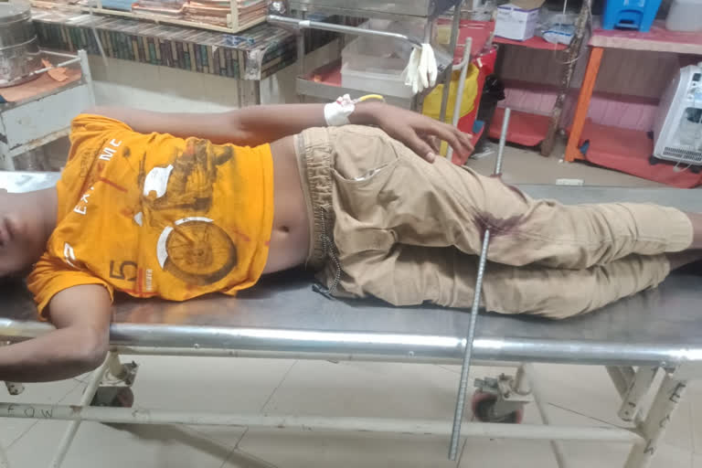 iron-rod-removed-from-katwa-boys-leg-in-critical-surgery