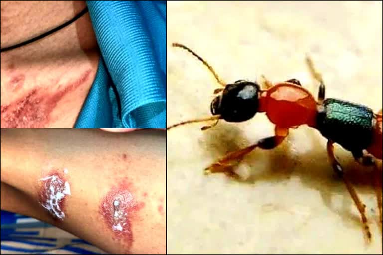 Acid Fly New terror in North Bengal  Acid Fly attacks  വടക്കന്‍ ബംഗാളിനെ ഭീതിയിലാഴ്‌ത്തി ആസിഡ് ഈച്ച  ആസിഡ് ഈച്ചക്കെതിരെ ജാഗ്രത വേണം  Nairobi fly attacks in north bengal  നെയ്‌റോബി ഫ്ലൈ  നെയ്‌റോബി ഈച്ചയുടെ ആക്രമണത്തില്‍ വടക്കന്‍ ബംഗാള്‍