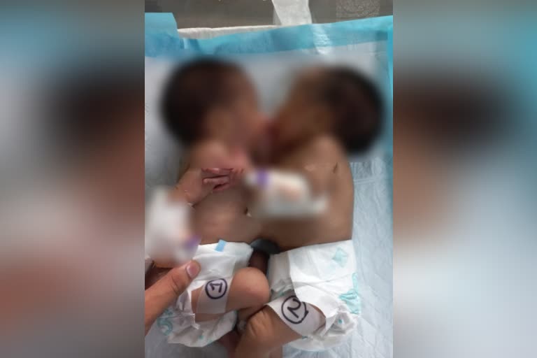 Conjoined Twins Operated in NRS