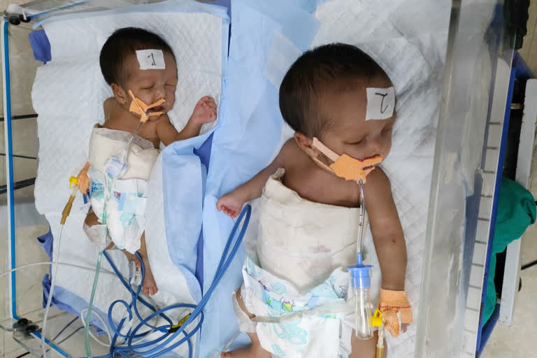 NRS doctors perform rare surgery to separate conjoined babies