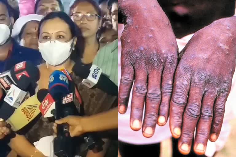 first case of monkeypox confirmed in india at kerala  monkeypox confirmed kerala first case in india  മങ്കിപോക്‌സ് ഇന്ത്യയിലും  ആദ്യകേസ് കേരളത്തിൽ  മങ്കിപോക്‌സ് കേരളത്തിൽ സ്ഥിരീകരിച്ചു  monkeypox in kerala  മങ്കിപോക്സ് ലക്ഷണങ്ങൾ  കുരങ്ങ് പനി  വാനര വസൂരി