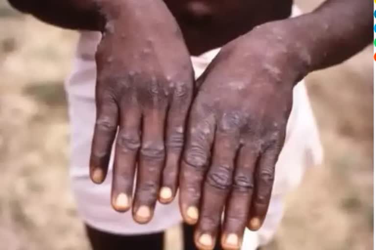 first case of monkeypox reported in kerala