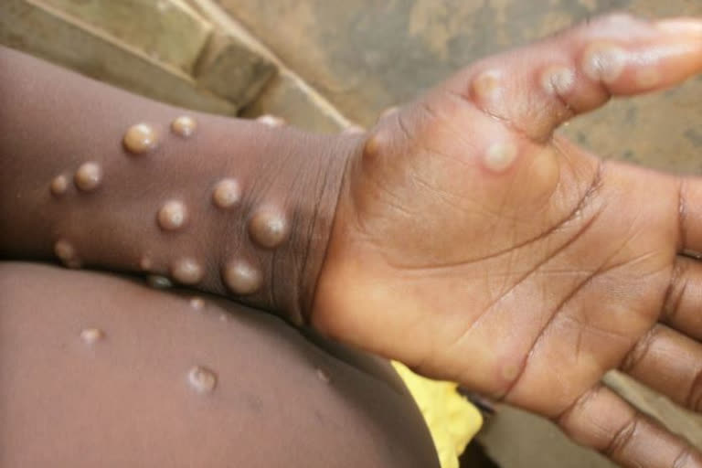WHO emergency committee meeting on consideration of declaring monkeypox a global emergency