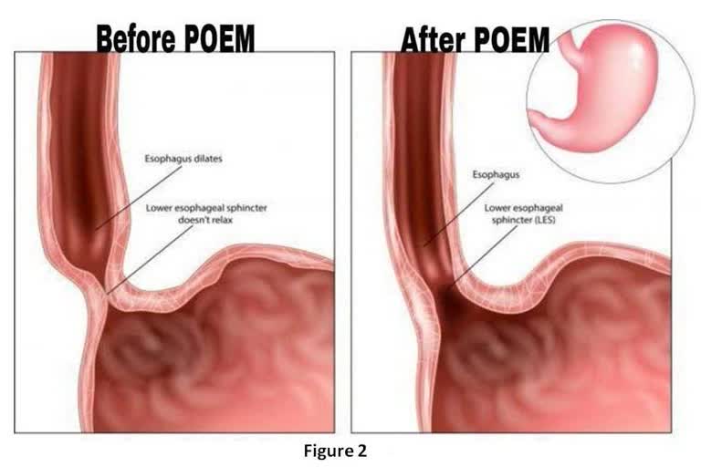 Special Endoscopic Procedures