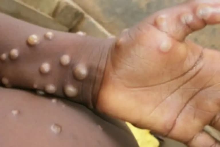 Delhi man with no travel history tests positive for monkeypox