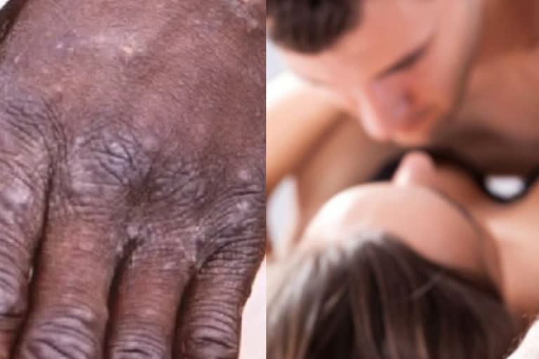 பாலியல் ரீதியாக பரவுமா குரங்கு அம்மை நோய்...? உலக சுகாதார அமைப்பின் விளக்கம்...