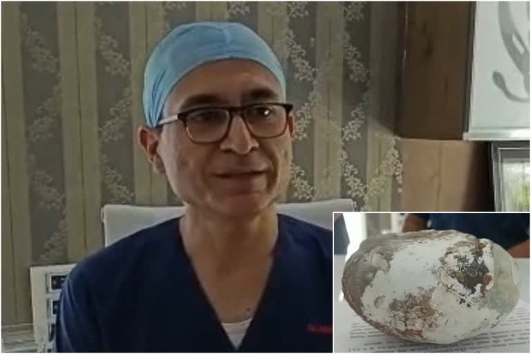 dhule doctor removes kidney stone  one kg kidney stone removed from farmers body  kidney stone removal surgery record  maharashtra farmer kidney stone removed  മഹാരാഷ്‌ട്ര വൃക്കയിലെ കല്ല് നീക്കം ചെയ്‌തു  വൃക്കയില്‍ നിന്ന് ഒരു കിലോ ഭാരമുള്ള കല്ല്  വൃക്കയിലെ കല്ല് നീക്കം ചെയ്യല്‍ ശസ്‌ത്രക്രിയ റെക്കോഡ്  ധുലേ ഡോക്‌ടര്‍ വൃക്കയിലെ കല്ല് നീക്കം ചെയ്യല്‍