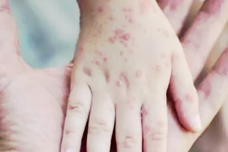 Monkey Pox patient discharge  ആദ്യ രോഗി ആശുപത്രി വിട്ടു  മങ്കി പോക്‌സ്‌  മങ്കി പോക്‌സില്‍ നിന്നും രോഗമുക്‌തി  ആദ്യമായി മങ്കി പോക്‌സ്‌ സ്ഥിരീകരിച്ചത്‌  Monkey Pox