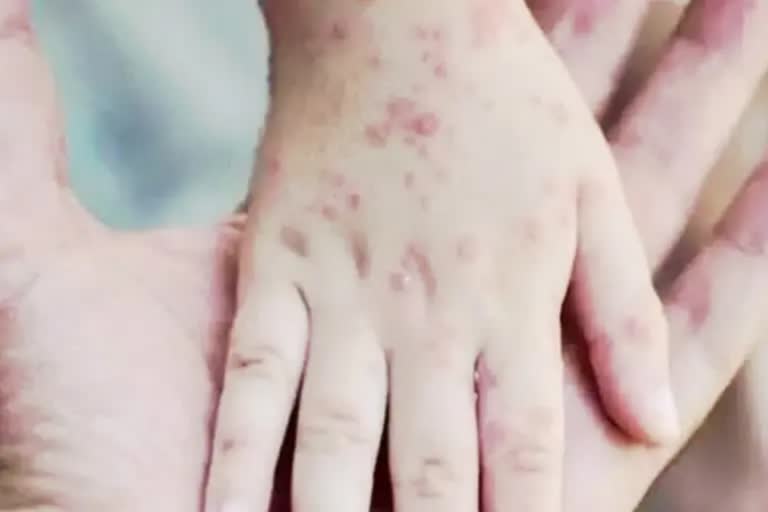 Monkeypox patient in India cured