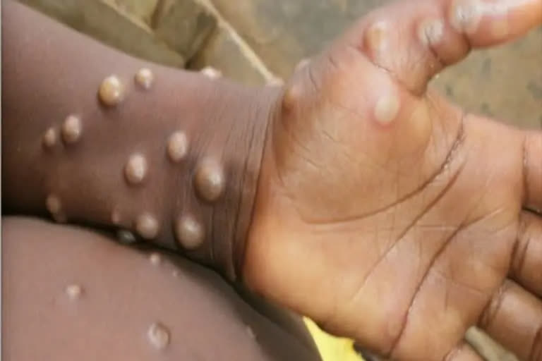 5th monkeypox case in Delhi