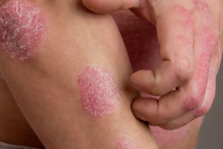 Psoriasis will completely cure with a Ayurvedic Oil discovered by late bengali researcher