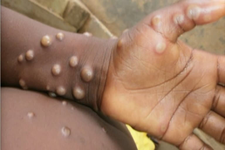 ICMR planning serosurvey among contacts of monkeypox patients