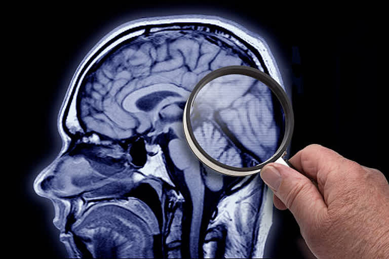 alzheimers-may-lead-to-loss-of-visual-memory-says-study