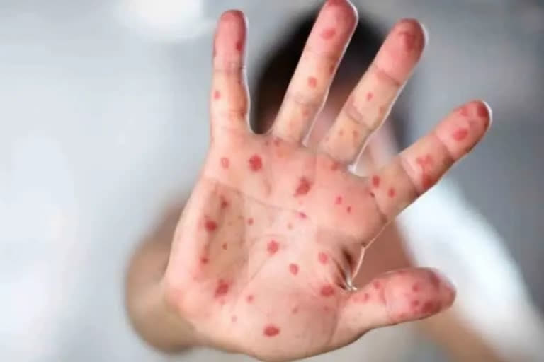 Health experts allay fears over Hand Foot and Mouth Disease