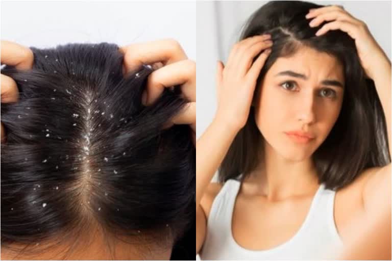 Dandruff Care News