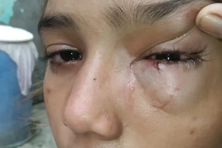 Girl injured in her eye after allegedly beaten by teacher accused held