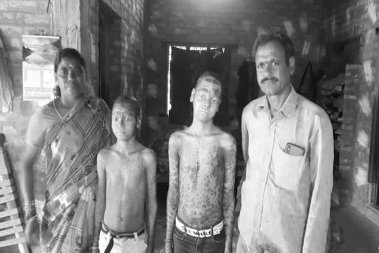Children suffering with rare skin disease Ichthyosis in Challagarige