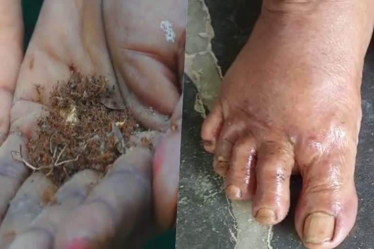 Poisonous Ant  Poisonous Ant Attack  Odisha News  Brahmansahi  Poisonous Ant Attack in Odisha  Villiagers  hometown  ഉറുമ്പുശല്ല്യം  നാടുവിടാനൊരുങ്ങി ഗ്രാമവാസികള്‍  ഗ്രാമവാസികള്‍  ഒഡിഷ  ഒഡിഷ വാര്‍ത്തകള്‍  ബ്രാഹ്മണ്‍സാഹി  ചുവന്ന ഉറുമ്പുകളുടെ ആക്രമണത്തില്‍  ആക്രമണം  ഗ്രാമവാസി