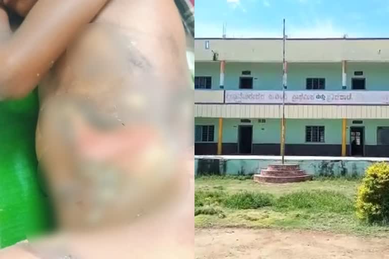 assault-by-teacher-on-student-by-throwing-hot-water-in-raichur