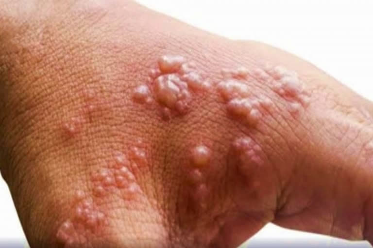 Monkeypox outbreak slowing in US, officials urge caution