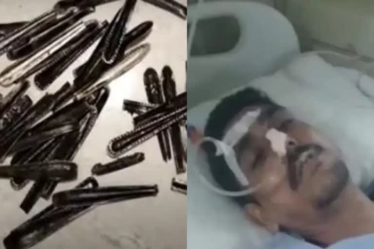 3 steel spoons found in man's stomach in muzaffarnagar