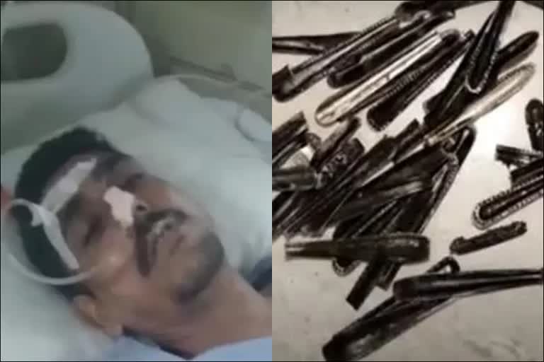 Muzaffarnagar addict ate 63 steel spoons  addict ate 63 steel spoons  Shamli De addiction Center  Ivan Multi Specialist Hospital  ವ್ಯಕ್ತಿಯ ಹೊಟ್ಟೆಯಲ್ಲಿದ್ದವೂ ಬರೋಬ್ಬರಿ 63 ಸ್ಪೂನ್​ಗಳು  ಶಸ್ತ್ರಚಿಕಿತ್ಸೆ ನಡೆಸಿದ್ದ ವೈದ್ಯರಿಗೆ ಅಚ್ಚರಿ  ಉತ್ತರಪ್ರದೇಶದಲ್ಲಿ ಅಚ್ಚರಿ ಪ್ರಕರಣ  ಮಲ್ಟಿ ಸ್ಪೆಷಲಿಸ್ಟ್ ಆಸ್ಪತ್ರೆ  ಮಾದಕ ವ್ಯಸನ ನಿಗ್ರಹ ಕೇಂದ್ರ  ವಿಜಯ್ ಹೊಟ್ಟೆಯಲ್ಲಿದ್ದ 63 ಸ್ಟೀಲ್ ಸ್ಪೂನ್