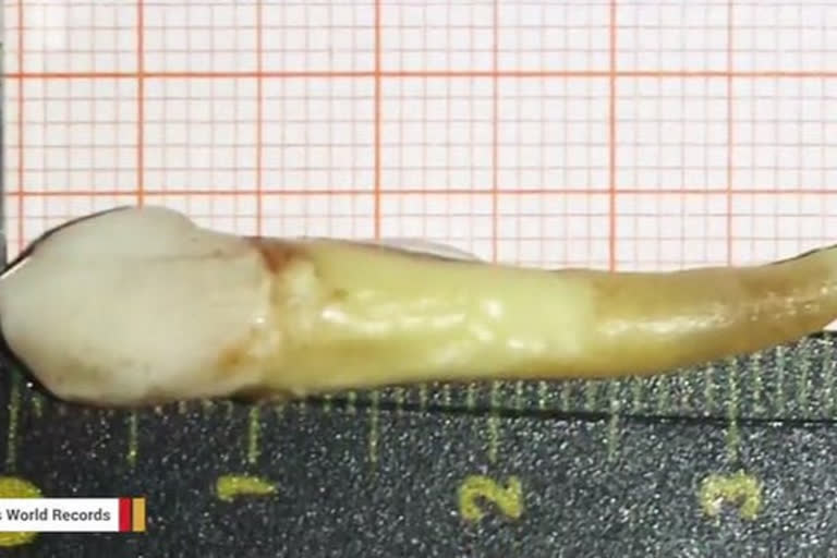 بڈگام میں ڈاکٹروں نے مریض کے منہ سے دنیا کا سب سے لمبا دانت نکالا