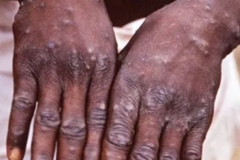 monkeypox bangalore cases today