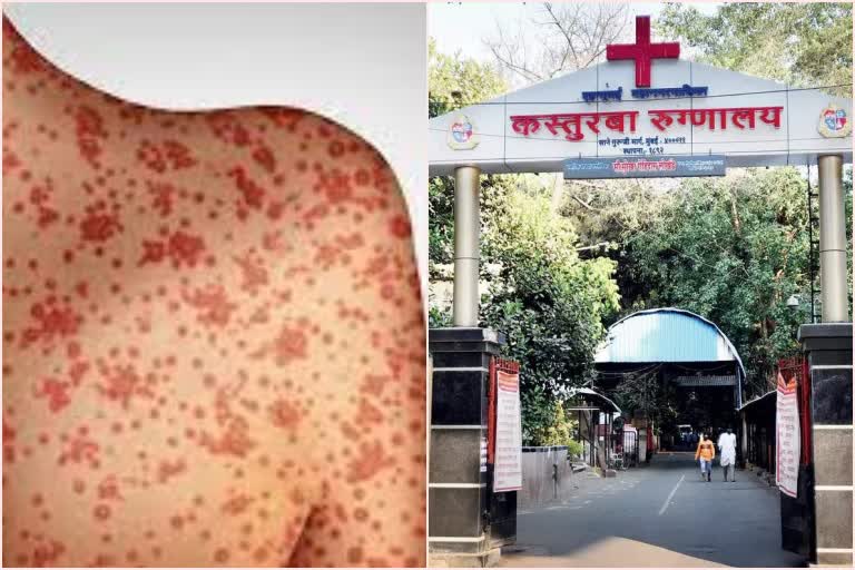 Measles Outbreak Mumbai