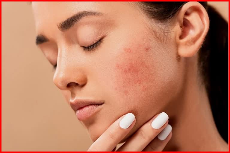 Face spots will disappear follow these home remedy