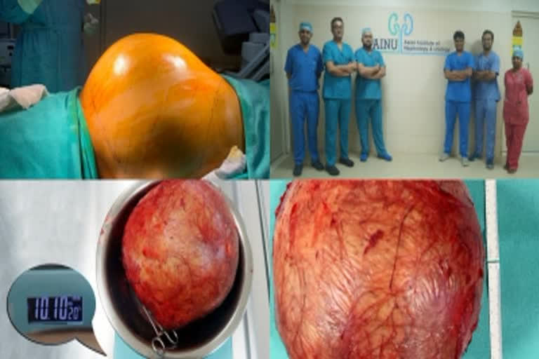 Doctors at Hyderabad hospital remove football-sized kidney tumour