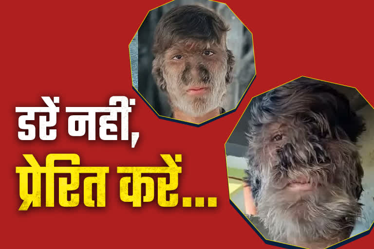 Werewolf Syndrome Etv Bharat