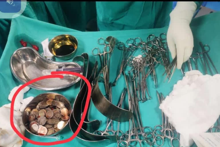 187 coins weighing more than 1 kg recovered from Bagalkot man stomach