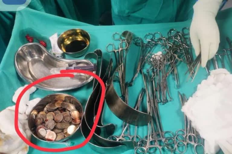 karnataka man swallows 187 coins