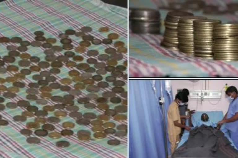 Doctors removed 187 coins from patient's body in Bagalkot Karnataka