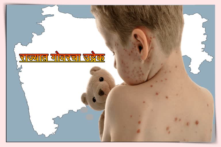 Measles Patients