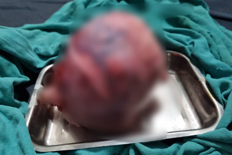 Punjab: 3.5 kg tumor removed from woman's stomach