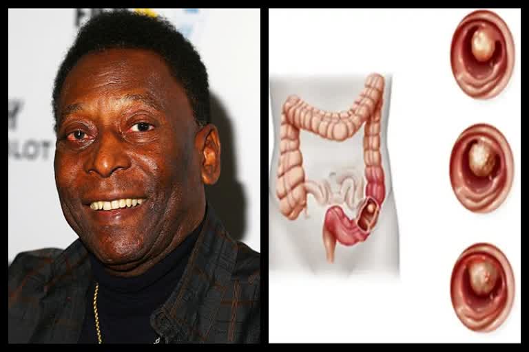 Pele's health problem; How to get rid of colon cancer?