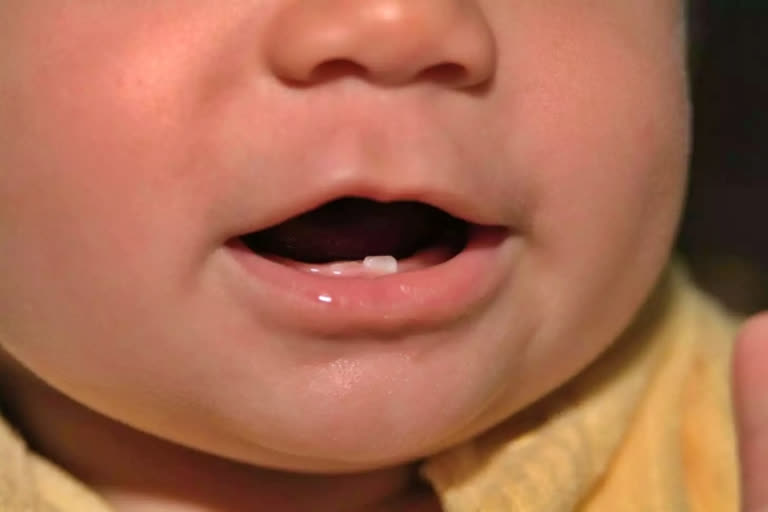 Natal Teeth: Causes and Complications
